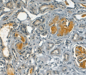 Rabbit anti Human C4d antibody  stained on human kidney from a patient with lupus erythematosus 
