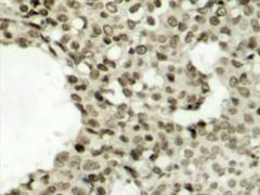 Immunohistochemical analysis of paraffin-embedded human breast carcinoma tissue using Rabbit anti STAT1 (pSer727) antibody