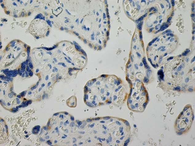 Staining of formalin fixed, paraffin embedded human breast carcinoma with mouse anti-human CD68 antibody